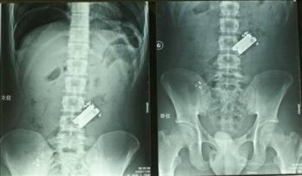 Ar alkoll gen hastaneye geldiinde doktorlar neden bu kadar karn ars ektiini anlamad... Ta ki gen yz st yatp da televizyon kanal deiinceye kadar. 19 yandaki Huang Chen isimli gen, ar alkol aldktan sonra kumanday yutmutu.