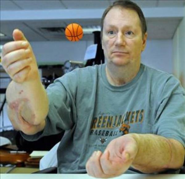 Hem sa hem sol eli transplant olan Jeff Kepner kk lastik bir topla antrenman yapyor.