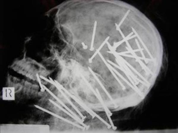 27 yandaki Chen'in cesedini inceleyen uzmanlar, byk ok yaad. Chen'in kafatasnn rntgeni ekildiinde kafasna bir sr ivi aklm olduu grld. ncelemeden sonra Chen'in ivi tabancas ile ldrld anlald.