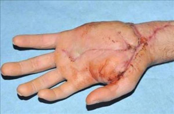 Bir metro kazasnda iki elini birden kaybeden hastann sa eli sol koluna takld. Talihsiz kaza kurbannn sa eli o kadar kt yara almt ki doktorlar sol n koluna yaptrdlar.