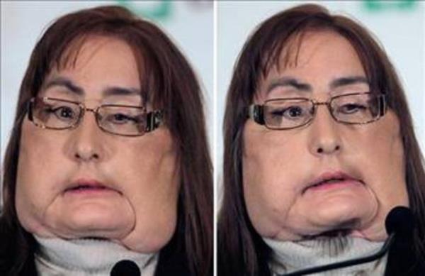 Amerika'da ilk yz nakli operasyonu hastas Connie Culp bir basn toplantsnda konuuyor.