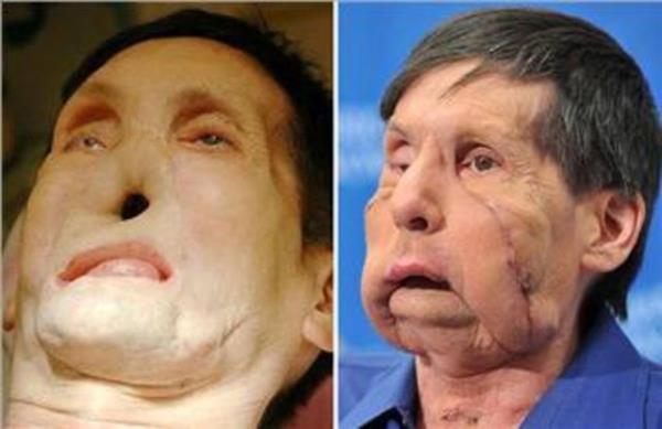 59 yandaki James Maki, ikinci yz nakli operasyonunu geiren kii oldu. 17 saatlik operasyon geiren hasta, metro kazasnda yaralanmt.