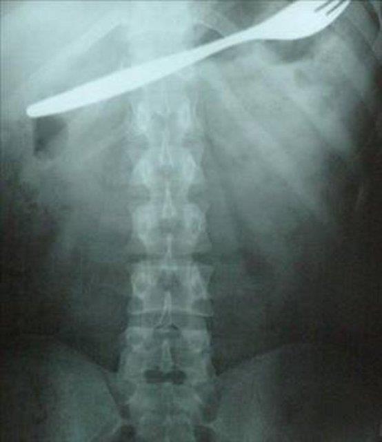 Kahramanmara'n Afin ilesinde bir gen kz, karn ars ikayetiyle gittii hastanede, midesinde atal olduunu renince ok oldu. Gen kzn atal kk yata yuttuu sanlrken, atal baarl bir ameliyatla karld.