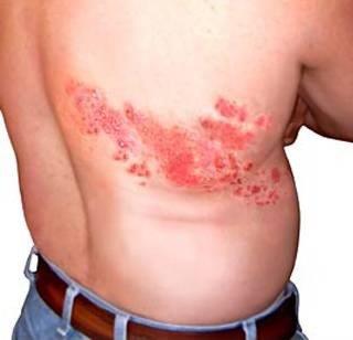 <p><b>ZONA:</b></p>   Zona olarak da bilinen Herpes Zoster su iei virsnn yapt bir enfeksiyondur.