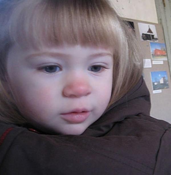 7.Souktan ve silmekten kzarm burunlar