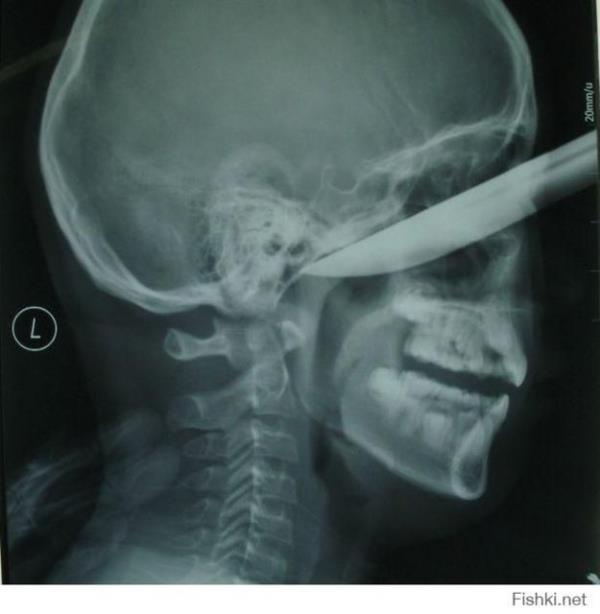 Elma soyarken gzne bak girdi.