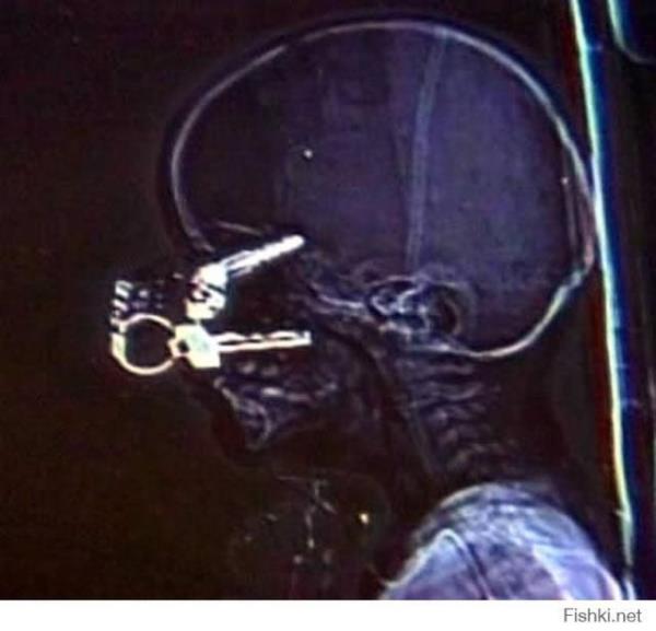 17 aylk ocuun gzne anahtar sapland.