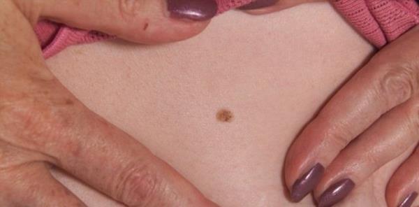 Cilt kanseri, 25-29 ya aralndaki insanlar arasnda en sk rastlanan kanser trdr. Ayrca her 5 kiiden biri yaam sresince cilt kanseri gelitiriyor.