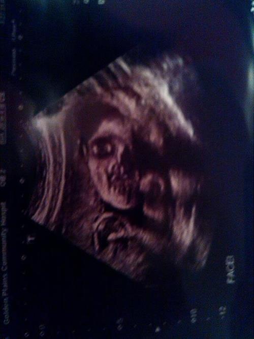 5. 1991'de ekilen, gerek bir ultrason grnts