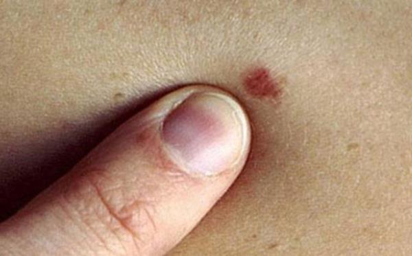 5-Bulgular taknt haline getirmeyin