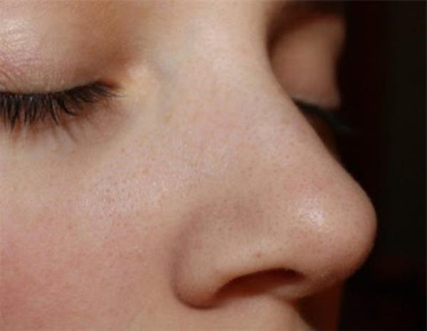 Bu grnt her insan iin geerli fakat ya salgs fazla olan kiilerde gzenekler de daha geni.