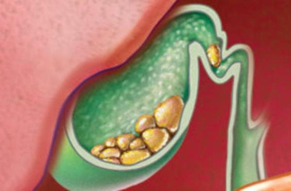 1-Kolesterol talar: Safra kesesi iinde kolesterol birikmesi nedeniyle oluan bu talar, safra talarnn %80?ini oluturuyor.
