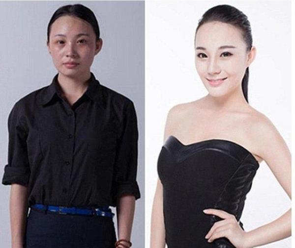 Burun estetii ve ene implant operasyonu sonras.