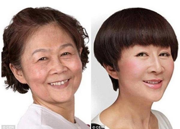 Burun ve botox yaptrmtr.