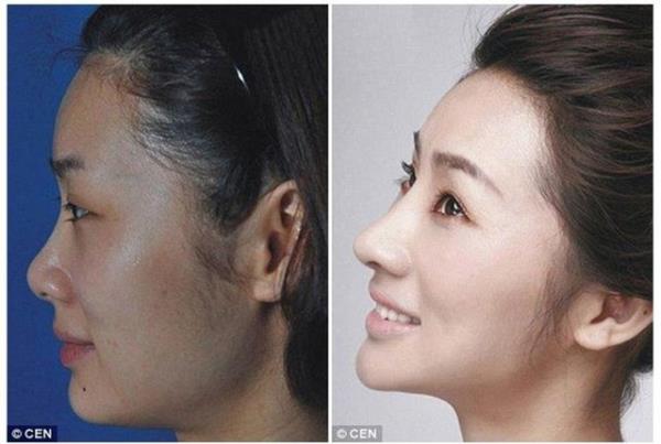 Gao Shanshan?a burun, ene ve botoks enjeksiyonu uygulamalarndan sonra ki byk deiimi.