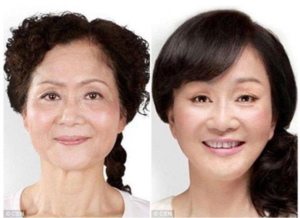 Yz gerdirme ve burun estetii olmutur.