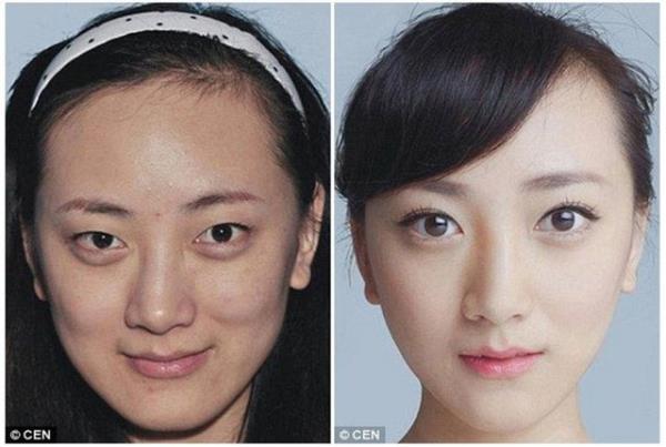 Ofis ynetici Lui?nin gz kapa ve gz torbalarna yaplan estetik sonras yaad deiim.