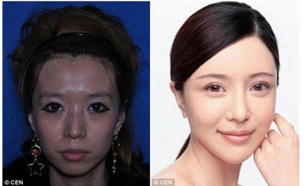 arkc Zhang Cher?in ameliyat ncesi ve sonras.