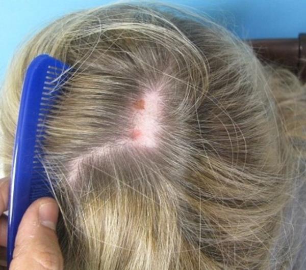 Bu kiiler salar haricinde vcutlarnda kalar, kirpikleri, sakallar gibi vcutlarndaki dier kllar da ekme istei duyuyor. Bu taknt ounlukla vcutta kolay fark edilebilir kelliklere yol ayor.