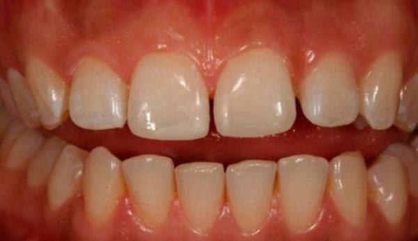 Son olarak da son derece Freudyen bir yaklamla kadnlar iin damakta oluan bu boluun bir temenni bir doyuma ulamay simgeledii ve bu nedenle ryay gren kadnn ocuk sahibi olmak istedii anlam ykleniyor.