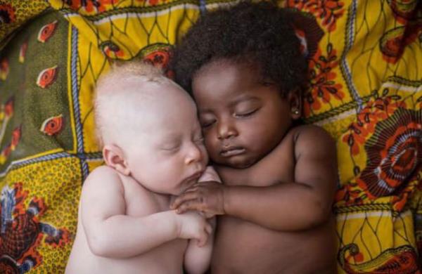 Kongo Kinshasa'da kuzeniyle beraber mutlu bir ekilde uyuyan 3 haftalk Albino bebek