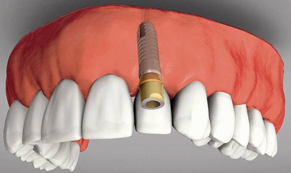 EK NOT: Bu arada "implant" uygulamalar zayf bnyelerde di kklerinde bulunan yukarda belirtilen virslerin kana karmas sonucu baklk sisteminin iflas ile kiinin 6 ay - 1 yl gibi srelerde kanserden hayatn kaybetmesine neden olmaktadr. Gelimi lkelerde ve zellikle Amerikada bu uygulamalar ok zor ve kstlanm durumdadr. Bu nedenle ene kemii ile opersyonlardan uzak durmalyz.