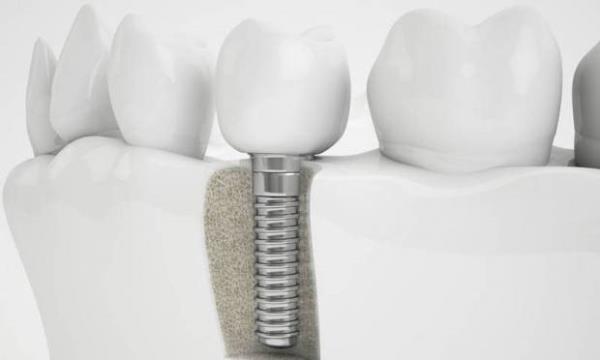 * Bunu da mmkn olduunca duyurmak insani bir grev. Yurdumuzda harl harl "implant" yaplyor. Ama TCARET olsun tabi... te bu virs ldren ad san olan bir ila var, bir de karbonat ok etkili.!<br>