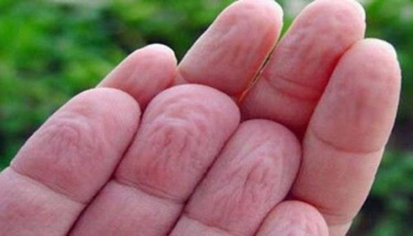 Bu da derideki hcrelerin imesine neden olur. Hcreler alt tabakadaki dokulara bal olduklarndan deri bu duruma uyum salayabilmek iin buruur.