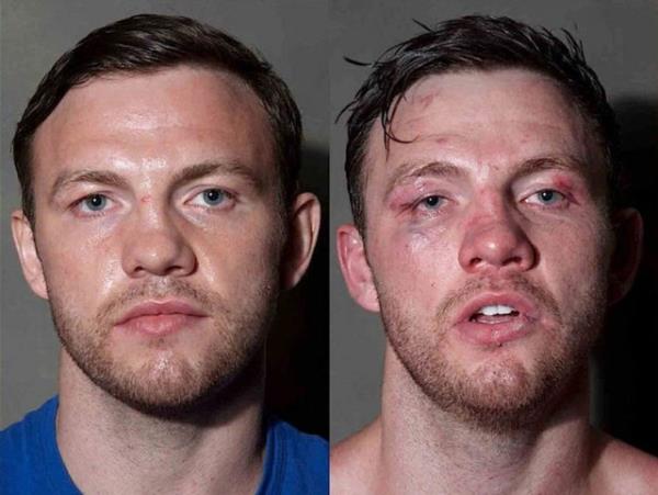 <b>8 boksrn ma ncesi ve sonras halleri</b>