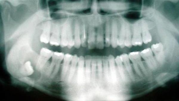 Bu sebeple, daha geni bir az daha retken klmak iin ilave bir takm az diimiz mevcuttu. Sellozun vcut tarafndan yeterli ekilde sindirilmesi kabiliyetinden yoksun olunduu iin bu zellikle gerekliydi.
