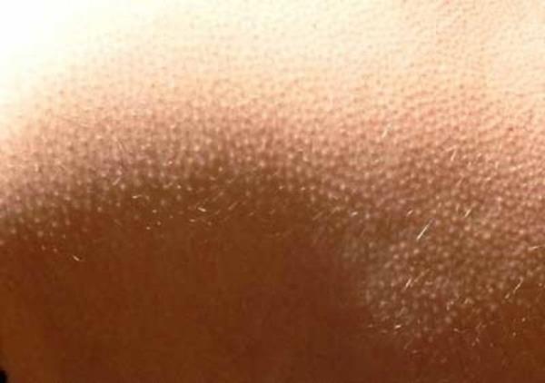 Mesela, kedi veya kpek tylerinin dikilmesi, kirpi dikenlerinin ortaya kmas bu sebeptendir. me durumunda, dikilen tyler havay deri ve tyler arasnda sktrr ve bylelikle yaltm ve scaklk salar.