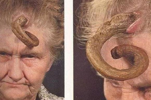 Cutaneous Horns Korn kutaneum (deride boynuzsu knt), uzunluu birka milimetre ile birka santimetre arasnda deien, boynuzumsu grnmde hiperkeratotik lezyonlardr. Korn kutaneum sklkla yz, kulaklar ve gne gren dier alanlarda grlr.