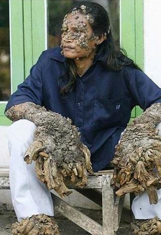 Epidermodysplasia Verruciformis