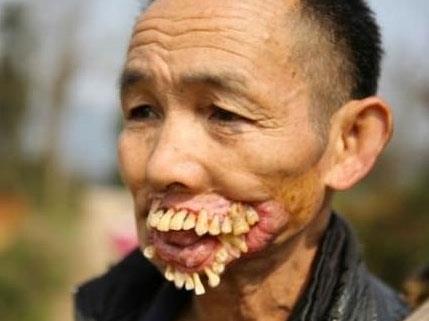 Noma  <br>  Dieti veya yanakta siyaha yakn renkte bir lser yani yara eklinde balar. Ksa zamanda etrafa yaylr.