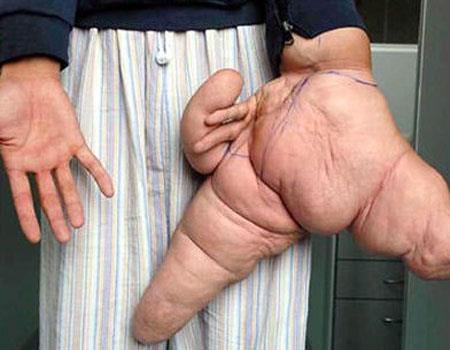 Macrodactyly  <br>  El ve Ayak parmaklarnn ar iri oluu