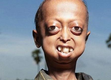 Progeria