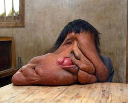 Neurofibromatosis  <br>  Neurofibromatosis (NF) kemikleri, yumuak dokuyu, deriyi ve sinir sistemini etkileyen genetik bir hastalktr.