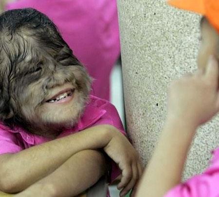 Hypertrichosis aka "Werewolf Syndrome"  <br>  Ar kllanma eklinde ortaya kmaktadr. Bu hastala yakalanan ocuklarn yzlerinde ve dier blgelerinde uzun siyah kllar kmaktadr. Hastalar kurtlara benzediklerinden, sz konusu hastalk, kurt adam sendromu olarak adlandrlmtr.