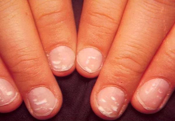 Trnaklardaki beyaz noktalar<br>    Uzmanlar bu noktalarn kaltmsal, yaralanma sonucu, ar manikr sonucu veya bilinmeyen baka sebeplerden kaynaklanabileceini belirtiyor.