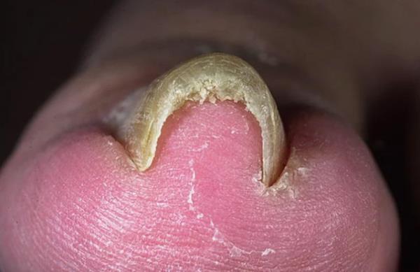 Kska trnaklar  <br>  Kska trnaklar ok farkl ekillerde kvrlm trnaklar ifade eder. Fazla manikrden kaynaklanabilecei gibi kaltmsal da olabilir veya tmr ya da yanl ayakkab seimiyle de alakal olabilir.