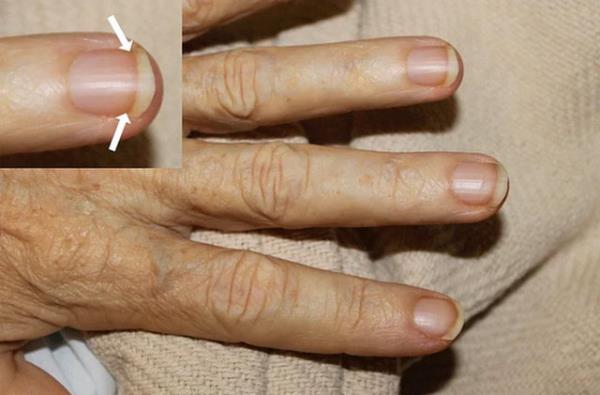 Ancak uzmanlara gre resimde grld gibi bir bozulma varsa bu karacier hastalna, konjestif kalp rahatszlna veya diyabete de iaret ediyor olabilir.