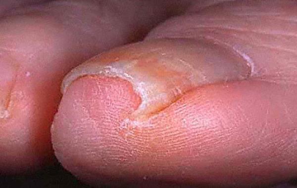 Ayak baparma trnann batmas  <br>  Baparmanzn trna kvrlarak derinize batyorsa, kaln trnakl biri olabilirsiniz.