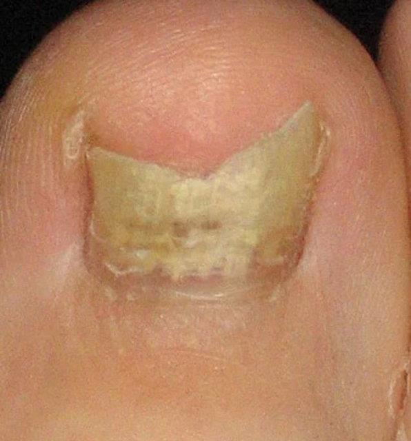 atlak veya krk trnaklar<br>    Trnanzn bir ksm renk deitirirse, atlarsa veya ksmen krlp koparsa bu trnak mantarna iaret eder.