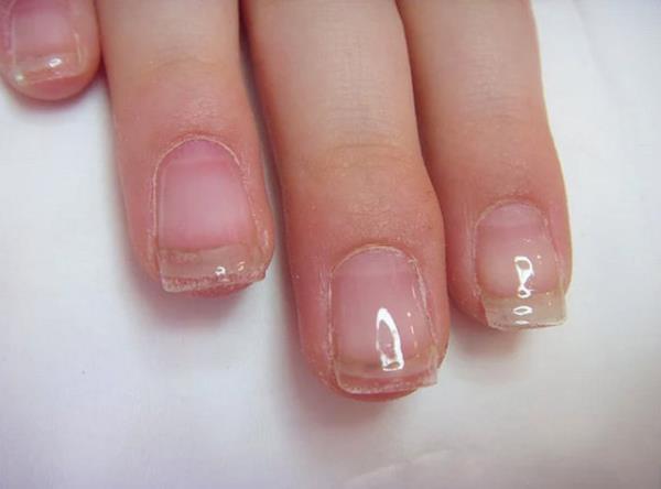 nce trnaklar<br>    "Jel trnaklar" ad verilen bu yap trnaklara ar kimyasal uygulanmasndan dolay ortaya kabilir.