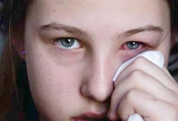 Son zamanlarda gz damlas kullanmaya balad m?