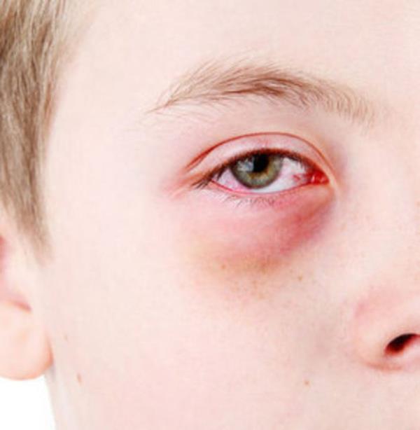 Fiziksel Belirtiler<br>  Gzlerde kzarklk ve gz bebeklerinde byme var m?