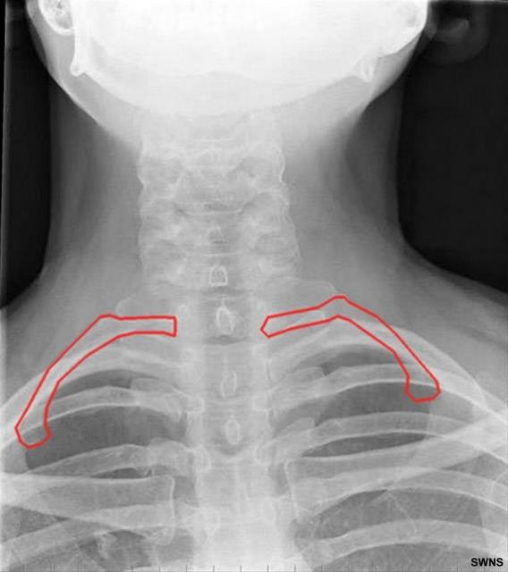 Her 20 kiiden birinin ve ounlukla da erkeklerin kaburga says 1 fazla.