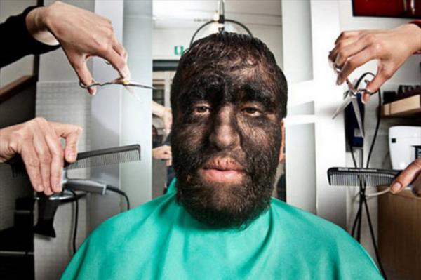 Guinness Rekorlar Kitab&#8217;nda dnyann en kll adam olarak yer alan Gomez kardelerin vcutlarnn yzde 98&#8217;i klla kapl bulunuyor