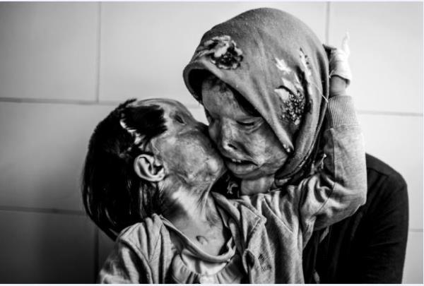 Kocas tarafndan yzne asit atlan anne ve olu.