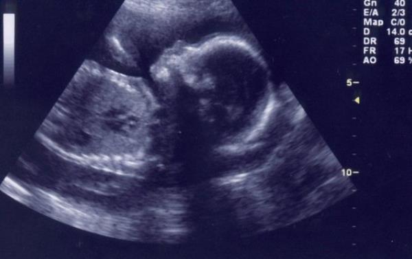 41- Ultrason<br>  Yanslanm